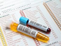Ai trecut de 40 de ani și ești mereu obosit? Pericolul ascuns din sângele tău pe care medicii te roagă să nu-l ignori. 19 analize medicale 1