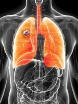 Boala care omoară 11 000 de români anual. Omoară predilect bărbaţi şi le dă, medical, puţine şanse