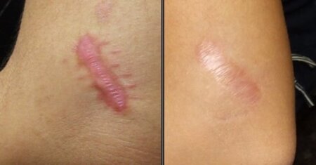 Uite cum să scapi definitiv de cicatricile rămase în urma rănilor! Încearcă aceste remedii naturale!