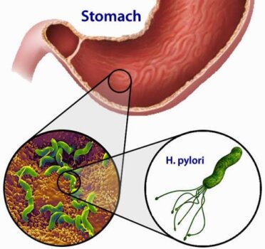 Tratament natural pentru INFECTIILE STOMACALE CU HELICOBACTER PYLORI