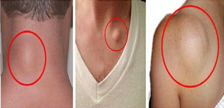 SUFERI DE NODULI SUBCATANAȚI (LIPOAME)? IATĂ CUM POȚI SCAPĂ DE EI ÎN DOAR 8 ZILE FĂRĂ A RECURGE LA OPERAȚIE!