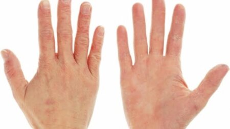 Boala ficatului gras. Semnul de pe palme care apare la 23% dintre cei care suferă de boli hepatice