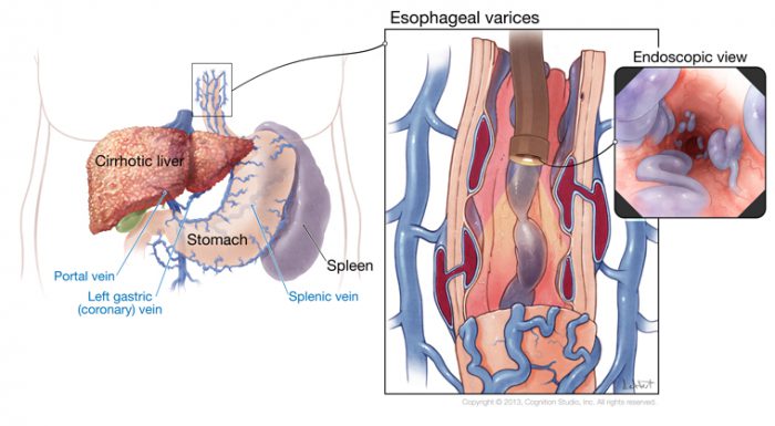 varice esofag 1