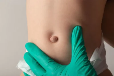 Factori de risc pentru dezvoltarea unei hernii